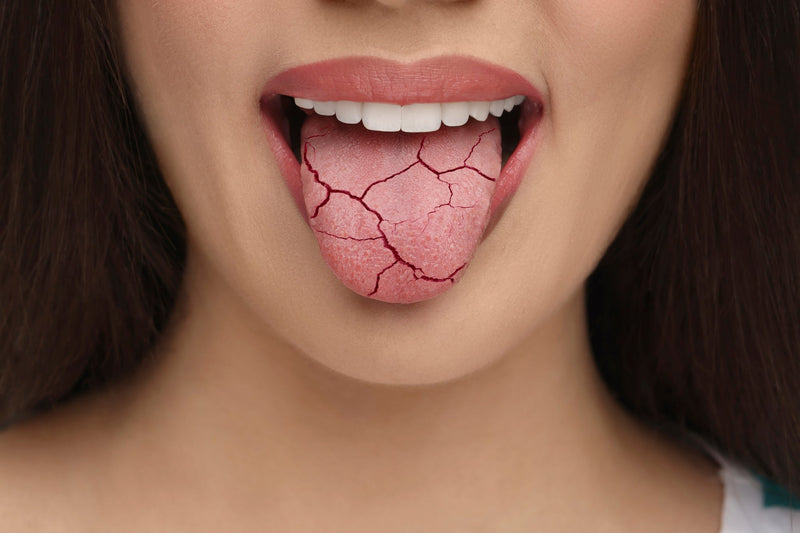dry mouth