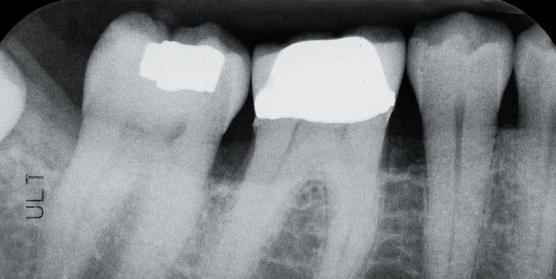 sensitive teeth