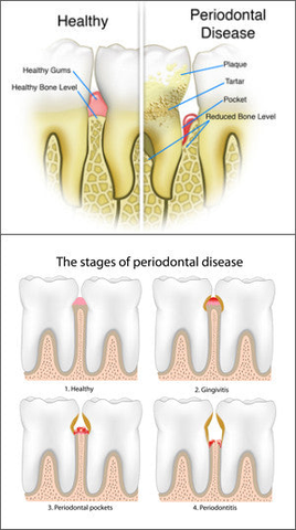 Healthy vs Periodontal Disease Comparison